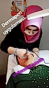 dermapen uygulaması