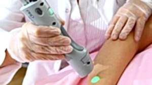 kalıcı dövme silme